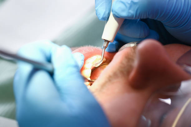 Best Emergency Root Canal Treatment in Palm River Clair Mel, FL